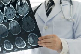  Descubren un gen clave para tratar el subtipo de cáncer cerebral más peligroso