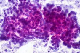  El color de la orina y la sed, los nuevos síntomas para detectar el cáncer de páncreas