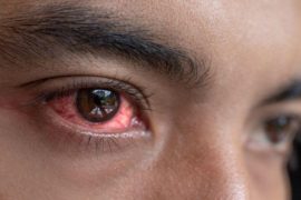  Hinchazón de ojos, picazón y otros síntomas del tracoma: qué es y cómo tratarlo