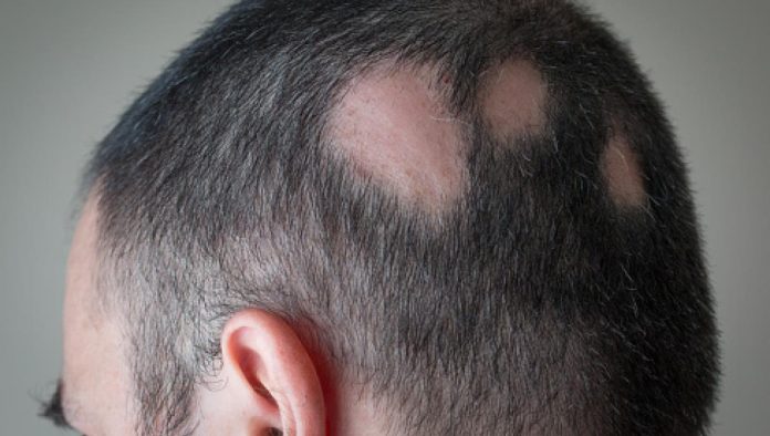  Aprueban la primera pastilla para combatir la alopecia