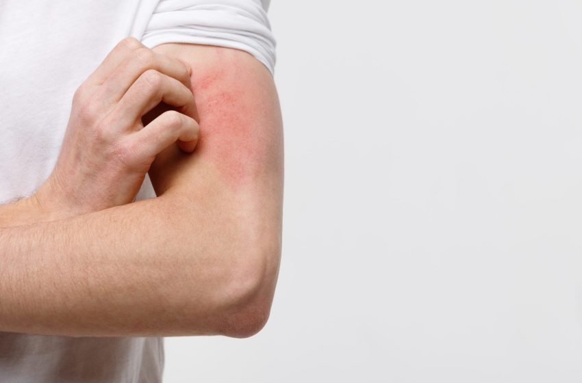  La dermatitis atópica impacta el bienestar social y emocional de quienes la padecen