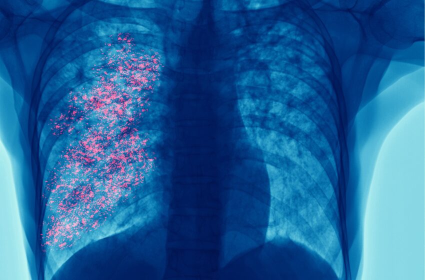  Cáncer de pulmón: detección temprana y prevención son claves para mejorar las oportunidades de tratamiento
